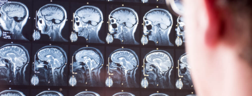 should I see a neurologist after an accident?